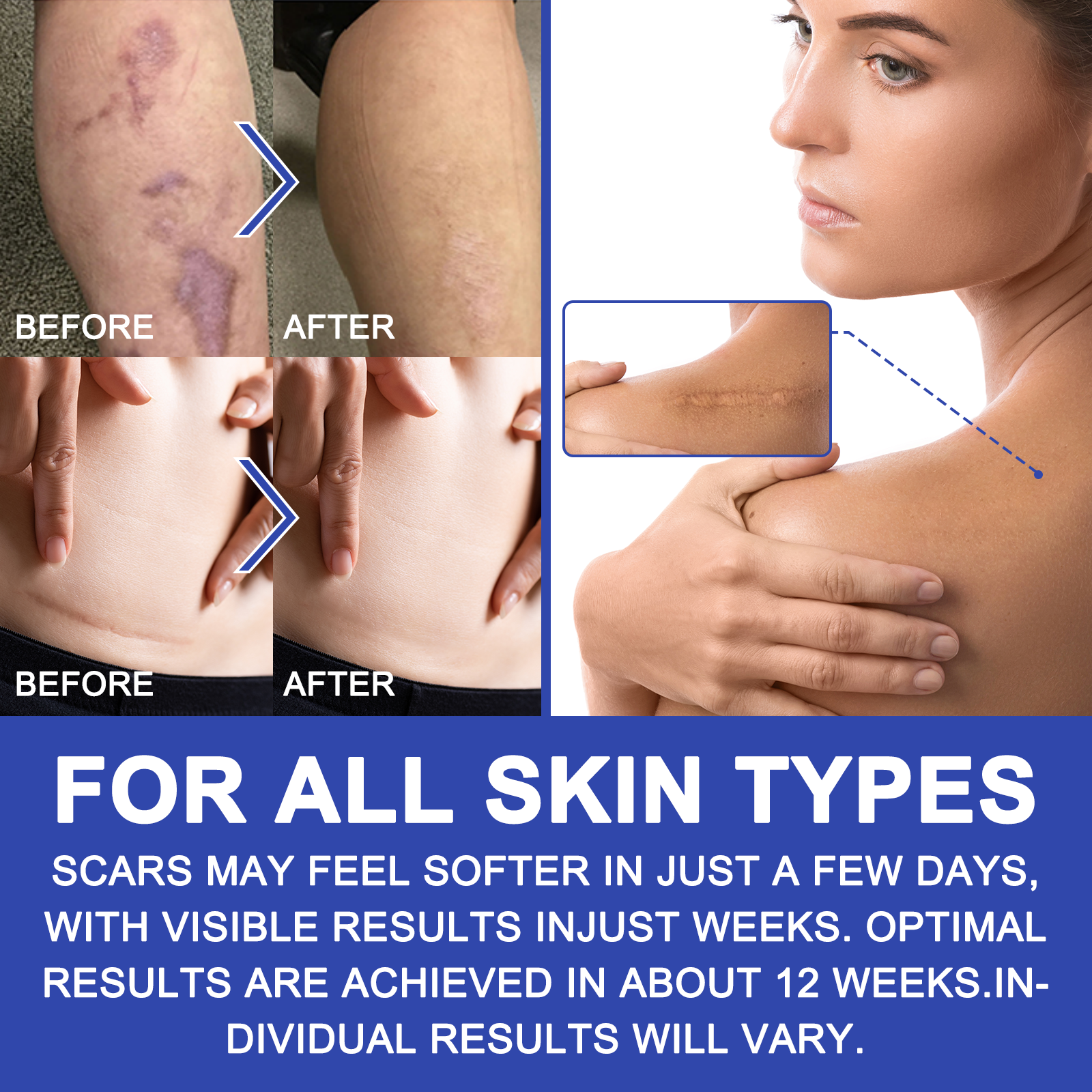 Waterproof Silicone Gel Scar Removal Roll – Customizable Treatment for Post-Surgery, Acne, and Stretch Marks